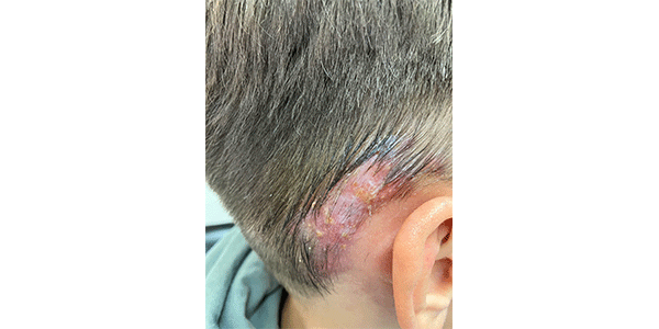 Bild: Tino Wetzig, Klinik für Dermatologie, Dermatochirurgie und Allergologie, Weißenfels