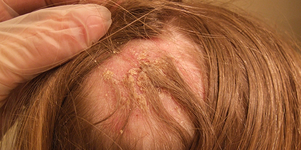 Tinea capitis durch Trichophyton benhamiae bei einem Kind nach Kontakt zu Meerschweinchen
